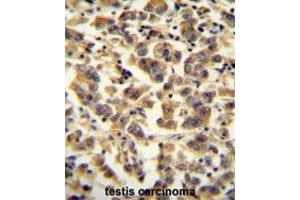 TTC39B antibody (C-term) immunohistochemistry analysis in formalin fixed and paraffin embedded human testis carcinoma followed by peroxidase conjugation of the secondary antibody and DAB staining. (TTC39B Antikörper  (C-Term))