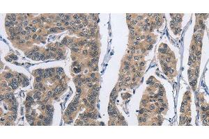 Immunohistochemistry of paraffin-embedded Human breast cancer tissue using DSG2 Polyclonal Antibody at dilution 1:50 (Desmoglein 2 Antikörper)