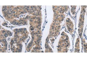Immunohistochemistry of paraffin-embedded Human breast cancer tissue using DSG2 Polyclonal Antibody at dilution 1:50