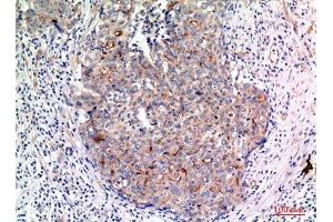 Immunohistochemistry (IHC) analysis of paraffin-embedded Human Breast Cancer, antibody was diluted at 1:100. (MUC1 Antikörper  (Internal Region))