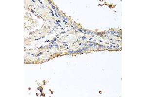 Immunohistochemistry of paraffin-embedded human lung cancer using INS antibody at dilution of 1:100 (40x lens). (Insulin Antikörper)