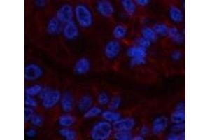 Immunofluorescence analysis of Human liver cancer tissue using CA9 Monoclonal Antibody at dilution of 1:200. (CA9 Antikörper)