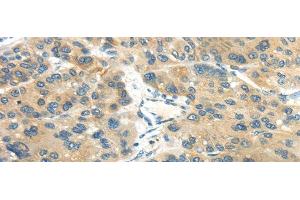 Immunohistochemistry of paraffin-embedded Human liver cancer tissue using CD70 Polyclonal Antibody at dilution 1:40 (CD70 Antikörper)