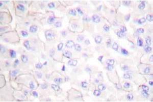 Immunohistochemistryanalysis of E-cadherin (pArg868) Antibody in paraffin-embedded human breast carcinoma tissue. (E-cadherin Antikörper)