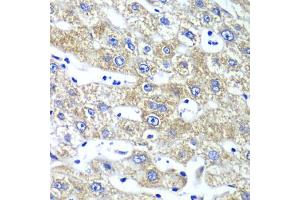 Immunohistochemistry of paraffin-embedded human liver injury using QARS antibody (ABIN5974184) at dilution of 1/100 (40x lens). (QARS Antikörper)