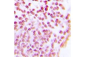 Immunohistochemical analysis of SIRT1 staining in human lung cancer formalin fixed paraffin embedded tissue section. (SIRT1 Antikörper)