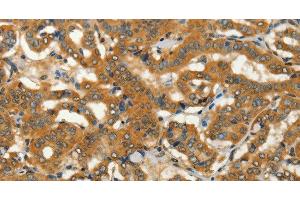 Immunohistochemistry of paraffin-embedded Human thyroid cancer using ADCY3 Polyclonal Antibody at dilution of 1:50 (ADCY3 Antikörper)