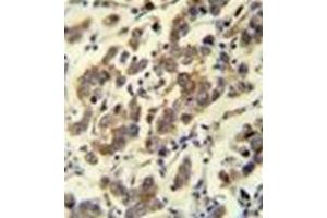 Immunohistochemistry analysis in formalin fixed and paraffin embedded human testis carcinoma reacted with MBD3L3 Antibody (C-term) followed which was peroxidase conjugated to the secondary antibody and followed by DAB staining. (MBD3L3 Antikörper  (C-Term))