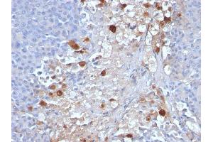 Formalin-fixed, paraffin-embedded human Melanoma stained with MCAM Mouse Monoclonal Antibody (MCAM/1101). (MCAM Antikörper)