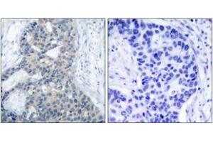 Immunohistochemistry analysis of paraffin-embedded human breast carcinoma, using Stathmin 1 (Phospho-Ser37) Antibody. (Stathmin 1 Antikörper  (pSer38))