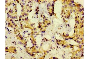 Immunohistochemistry of paraffin-embedded human liver cancer using ABIN7159562 at dilution of 1:100
