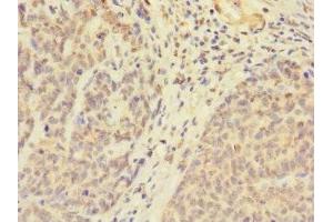 Immunohistochemistry of paraffin-embedded human ovarian cancer using ABIN7174603 at dilution of 1:100 (UBXN8 Antikörper  (AA 55-270))