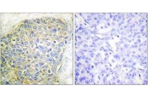 Immunohistochemistry analysis of paraffin-embedded human breast carcinoma tissue, using HSL (Ab-554) Antibody.