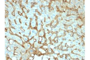 Formalin-fixed, paraffin-embedded human Hepatocellular Carcinoma stained with Albumin Mouse Monoclonal Antibody (ALB/2141). (Albumin Antikörper)