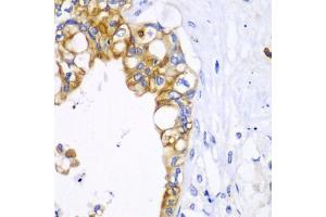 Immunohistochemistry of paraffin-embedded human liver cancer using BCL2 antibody. (Bcl-2 Antikörper)