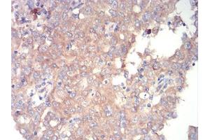 Immunohistochemical analysis of paraffin-embedded endometrial cancer tissues using mTOR mouse mAb with DAB staining. (MTOR Antikörper  (AA 2311-2529))
