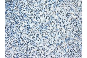 Immunohistochemical staining of paraffin-embedded Carcinoma of thyroid tissue using anti-PORmouse monoclonal antibody. (POR Antikörper)