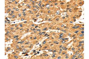 The image on the left is immunohistochemistry of paraffin-embedded Human liver cancer tissue using ABIN7131050(SH3KBP1 Antibody) at dilution 1/45, on the right is treated with fusion protein.