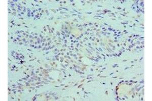 Immunohistochemistry of paraffin-embedded human breast cancer using ABIN7168694 at dilution of 1:100 (SLURP1 Antikörper  (AA 1-103))