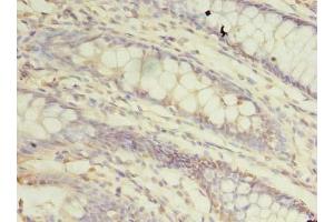 Immunohistochemistry of paraffin-embedded human colon cancer using ABIN7172361 at dilution of 1:100 (TRAPPC3 Antikörper  (AA 1-180))