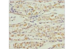 Immunohistochemistry of paraffin-embedded human gastric cancer using ABIN7164013 at dilution of 1:100 (KCNS3 Antikörper  (AA 1-180))