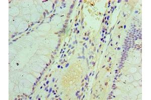 Immunohistochemistry of paraffin-embedded human colon cancer using ABIN7156671 at dilution of 1:100 (IFIT3 Antikörper  (AA 1-490))
