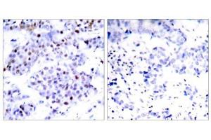 Immunohistochemical analysis of paraffin-embedded human breast carcinoma tissue using STAT6 (Ab-645) antibody (E021051). (STAT6 Antikörper)