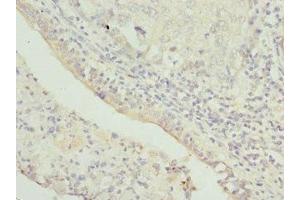 Immunohistochemistry of paraffin-embedded human lung cancer using ABIN7172352 at dilution of 1:100 (TRAPPC1 Antikörper  (AA 1-260))
