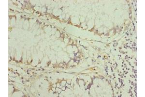 Immunohistochemistry of paraffin-embedded human colon cancer using ABIN7151254 at dilution of 1:100