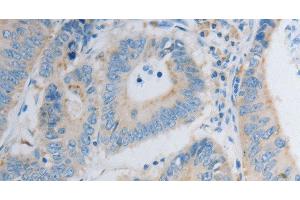Immunohistochemistry of paraffin-embedded Human colon cancer using PDX1 Polyclonal Antibody at dilution of 1:30 (PDX1 Antikörper)