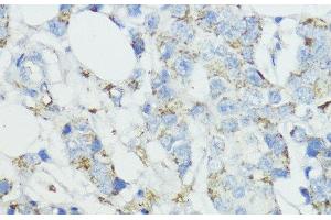 Immunohistochemistry of paraffin-embedded Human mammary cancer using SOD3 Polyclonal Antibody at dilution of 1:100 (40x lens). (SOD3 Antikörper)