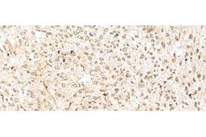 Immunohistochemistry of paraffin-embedded Human liver cancer tissue using RBX1 Polyclonal Antibody at dilution of 1:50(x200) (RBX1 Antikörper)