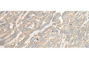 Immunohistochemistry of paraffin-embedded Human liver cancer tissue using RSU1 Polyclonal Antibody at dilution of 1:30(x200) (RSU1 Antikörper)