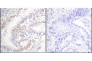 Immunohistochemistry analysis of paraffin-embedded human lung carcinoma, using FANCD2 (Phospho-Ser222) Antibody. (FANCD2 Antikörper  (pSer222))