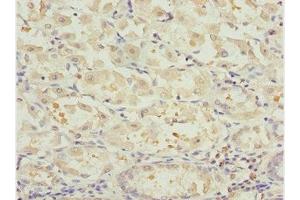 Immunohistochemistry of paraffin-embedded human gastric cancer using ABIN7161725 at dilution of 1:100 (NLE1 Antikörper  (AA 206-485))