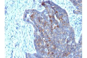 Formalin-fixed, paraffin-embedded human Ovarian Carcinoma stained with RBP1 (RBP/872) (RBP1 Antikörper)