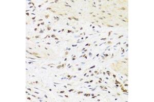 Immunohistochemistry of paraffin-embedded human breast cancer using SUMO4 Antibody. (SUMO4 Antikörper)