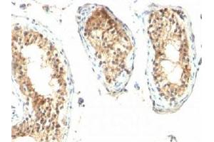 Formalin/paraffin human testicular carcinoma stained with ODC-1 antibody. (ODC1 Antikörper)