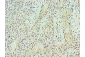 Immunohistochemistry of paraffin-embedded human breast cancer using ABIN7155529 at dilution of 1:100 (SUV39H2 Antikörper  (AA 201-410))
