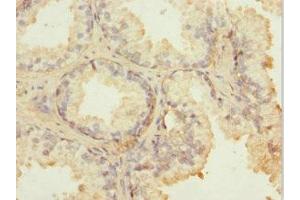 Immunohistochemistry of paraffin-embedded human prostate cancer using ABIN7143006 at dilution of 1:100 (FIBP Antikörper  (AA 1-364))