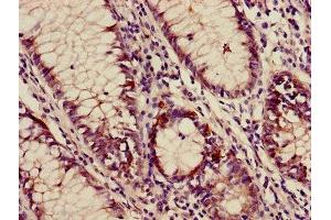 Immunohistochemistry of paraffin-embedded human colon cancer using ABIN7144378 at dilution of 1:100 (AP3M2 Antikörper  (AA 1-273))