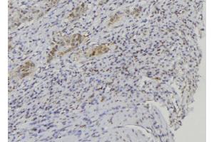 ABIN6272660 at 1/100 staining Human lung cancer tissue by IHC-P. (BPIFA1 Antikörper  (Internal Region))