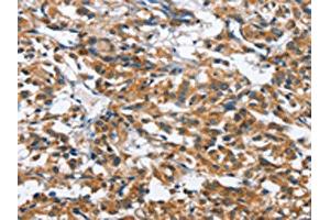 The image on the left is immunohistochemistry of paraffin-embedded Human thyroid cancer tissue using ABIN7128679(BPI Antibody) at dilution 1/50, on the right is treated with fusion protein. (BPI Antikörper)