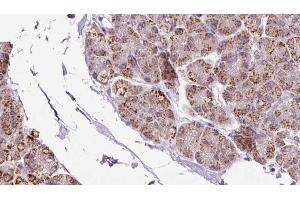 ABIN6273236 at 1/100 staining Human pancreas cancer tissue by IHC-P. (EIF2B1 Antikörper  (Internal Region))