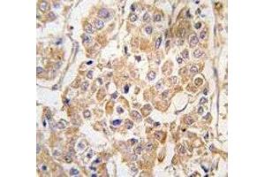IHC analysis of FFPE human breast carcinoma tissue stained with the IKKE antibody