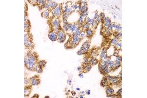 Immunohistochemistry of paraffin-embedded human liver cancer using GLUD2 antibody at dilution of 1:100 (x40 lens). (GLUD2 Antikörper)