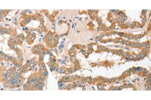 Immunohistochemistry of paraffin-embedded Human thyroid cancer using CD156c Polyclonal Antibody at dilution of 1:30