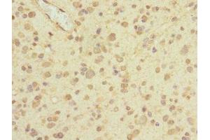 Immunohistochemistry of paraffin-embedded human glioma using ABIN7163444 at dilution of 1:100 (PIEZO1 Antikörper  (AA 2230-2420))