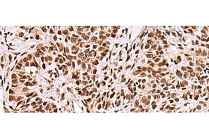 Immunohistochemistry of paraffin-embedded Human ovarian cancer tissue using FOXK2 Polyclonal Antibody at dilution of 1:50(x200) (Forkhead Box K2 Antikörper)