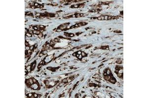Immunohistochemical staining (Formalin-fixed paraffin-embedded sections) of human breast cancer with MTDH monoclonal antibody, clone CL0397  shows strong cytoplasmic immunoreactivity in cancer cells.